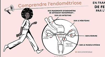 Endométriose : Des tests salivaires à l'étude pour améliorer le diagnostic